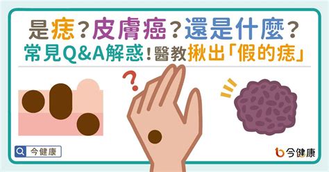 長痣的位置|是痣or皮膚癌？醫「1張圖秒對照」 長這2部位最危險